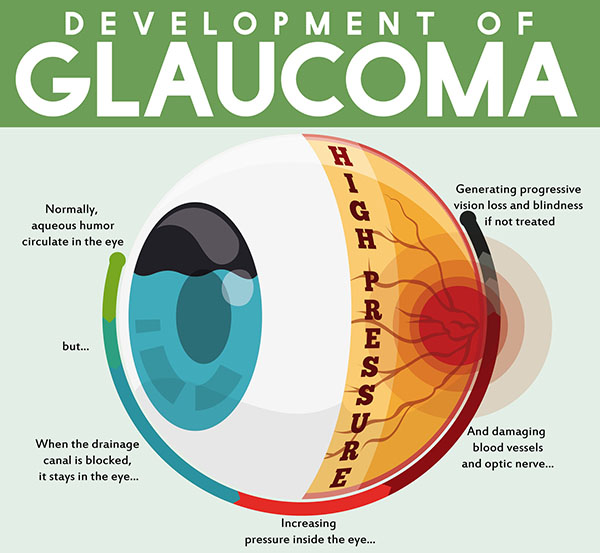 Infographic poster with detailed effects of untreated glaucoma disease showing the passing through a good and healthy eye to a progressive vision loss.
